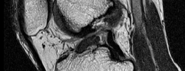 前十字靭帯断裂の自然治癒　ケース１６