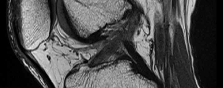 Non-Surgical Treatment of a Complete ACL Tear – case 16