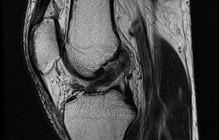 Natural Healing of a Complete ACL Tear – Case 19