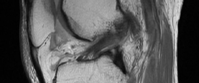 前十字韌帶撕裂自愈治療　案例 23