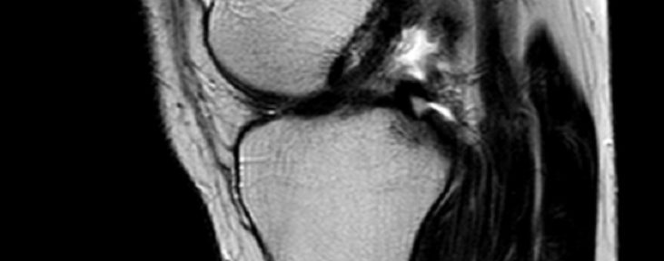 ACL Healing without surgery – Healed Case 28