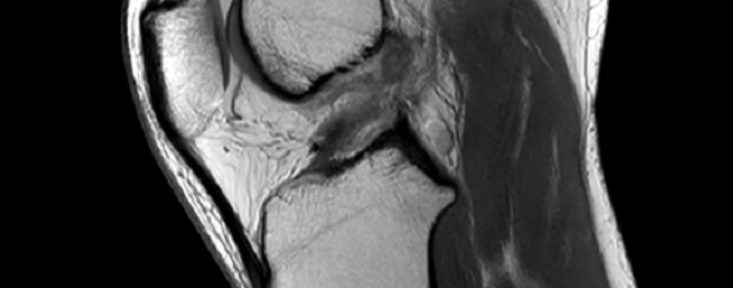前十字韌帶斷裂自然愈合　案例 ２９