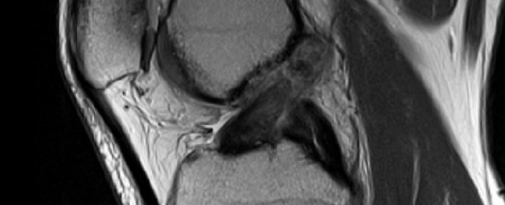 前十字交叉韧带断裂愈合　变形愈合　案例4