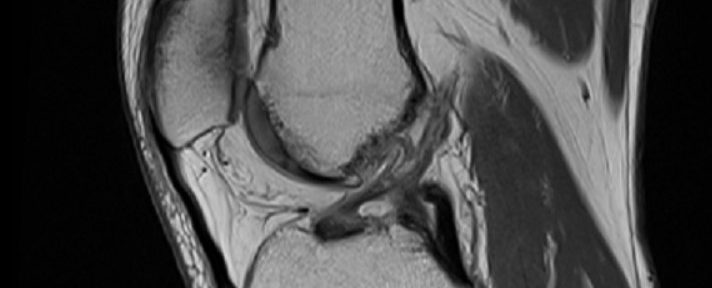 Degenerative Healing of an ACL Tear – Case 4