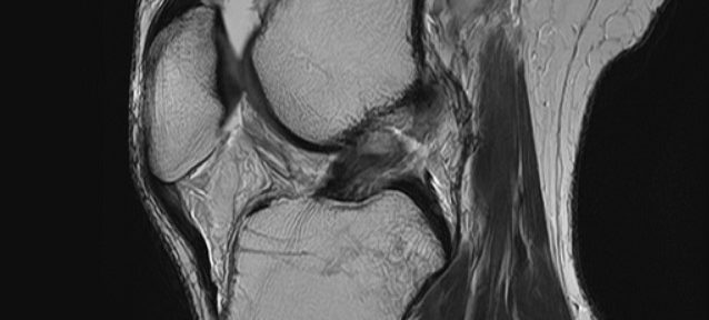 Degenerative Healing of an ACL Tear – Case 8