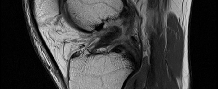 Degenerative Healing of an ACL Tear – Case 9