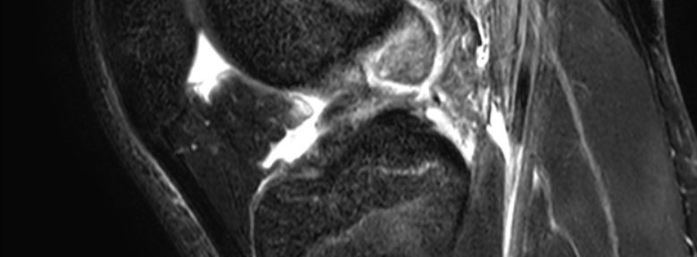 Degenerative Healing of an ACL Tear – Case 7