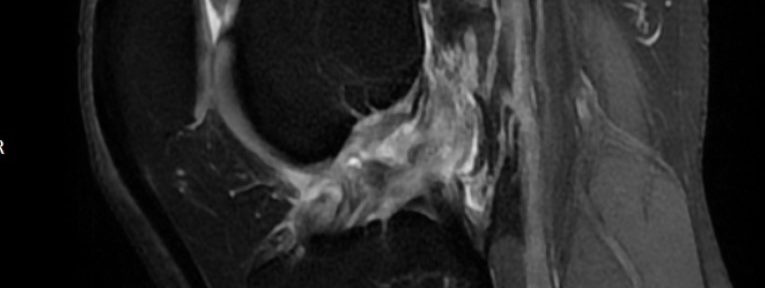 A Panamanian gentleman’s Natural Healing of ACL Tear -case 34