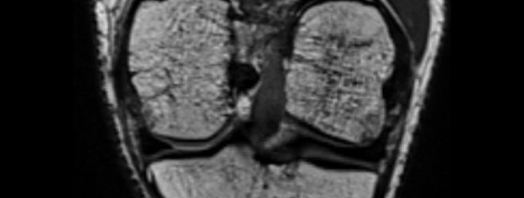 前十字靭帯断裂の自然治癒　ケース３７　反対側の前十字靭帯損傷にも気を付けて！