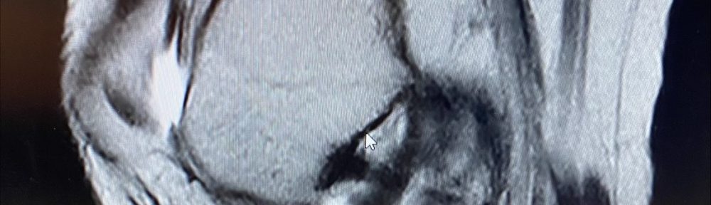 Natural Healing of an ACL Tear: Case Study of a 30-Year-Old Chinese Businessman