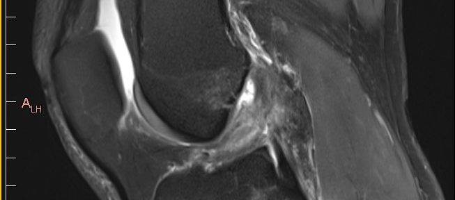 前十字靭帯断裂の自然治癒　ケース３６　中国系ビジネスマン