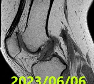 前十靭帯断裂の自然治癒　ケース３８