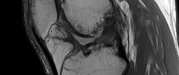 前十字靭帯再建術後に再断裂した靭帯の自然治癒に成功