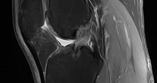 Natural Healing of a Re-ruptured ACL After Reconstruction