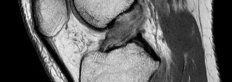 Donna di 42 anni guarisce naturalmente dal LCA grazie agli esercizi Evo-Devo: caso di una sciatrice di Singapore