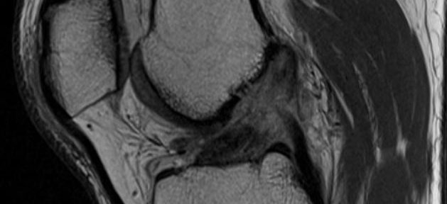 [Caso clinico 40] Rottura completa del legamento crociato anteriore guarita senza intervento: donna di 49 anni di Singapore (Grado IV Ihara)