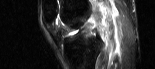 [Case 39] A 36-Year-Old Male Skier with a Complete ACL Tear Who Achieved Natural Healing through Evo-Devo Exercises: A Case Report