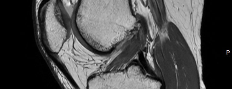 症例44｜前十字靭帯断裂から太く強い靭帯へ自然治癒｜松本じゅん接骨院