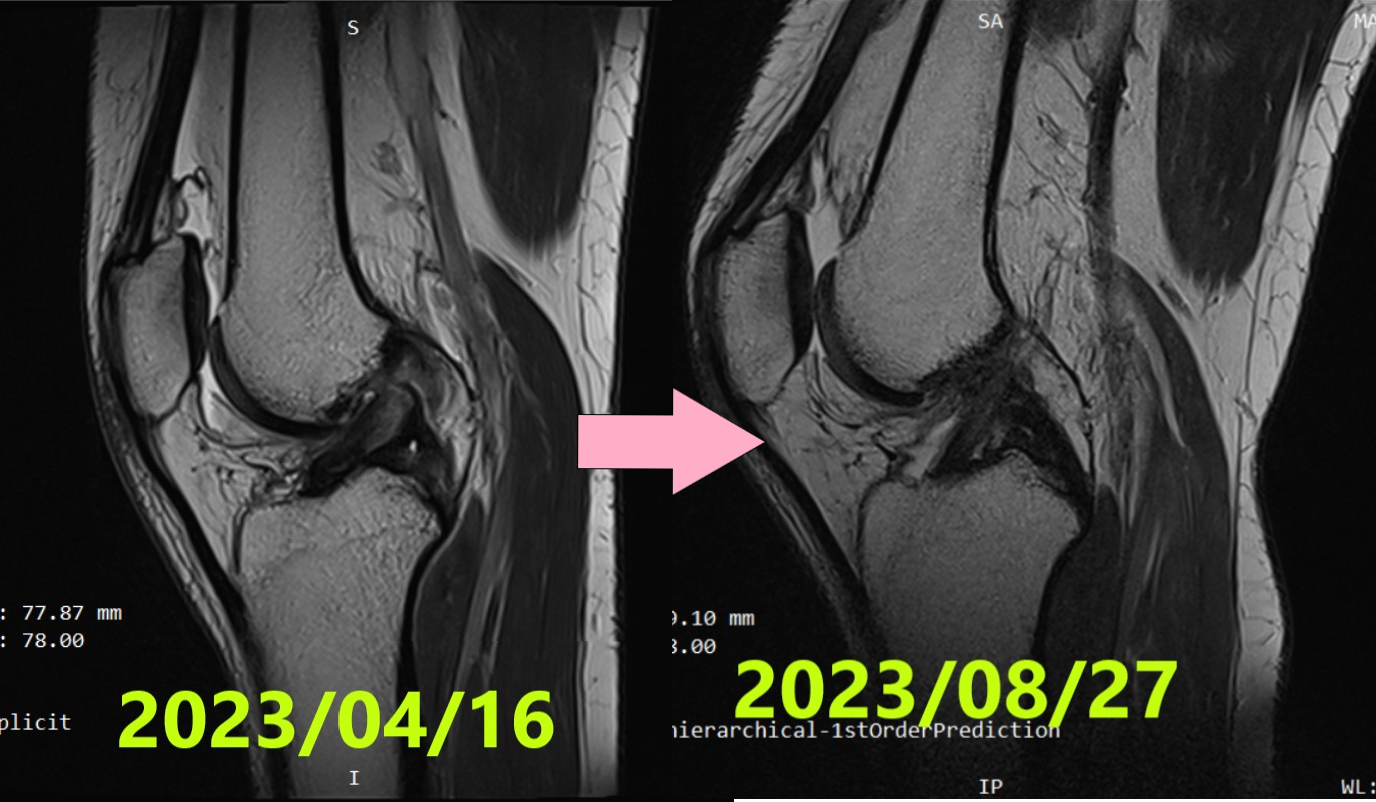 Caso 48|Curación natural de una rotura completa del ligamento cruzado anterior (mujer lituana de 25 años)