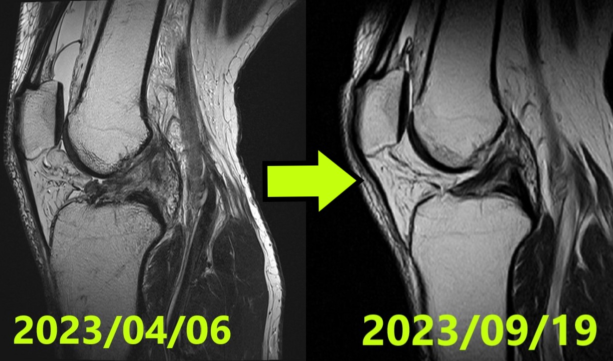 ACL Tear Natural Healing Case Report #50Case 50 | Natural Healing of Complete ACL Rupture: From Severe Ihara Type IV to Perfect Regeneration (ACLOAS Grade 0)