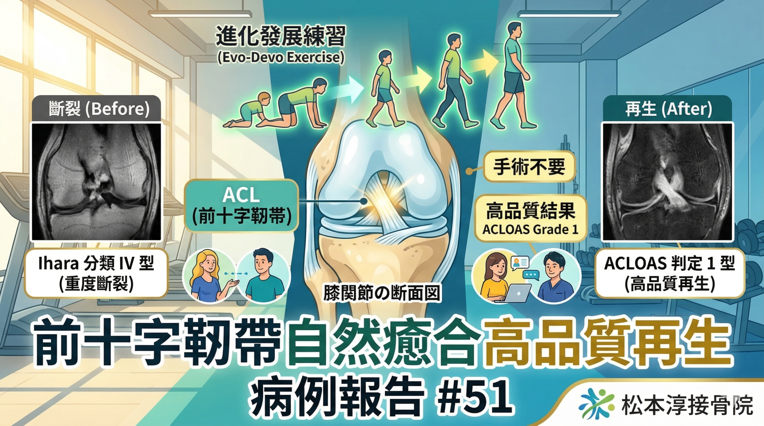 前十字韌帶自然再生病例 #51:羅馬尼亞 42 歲女性從重度 Ihara IV 恢復至高品質 ACLOAS 1 之實錄